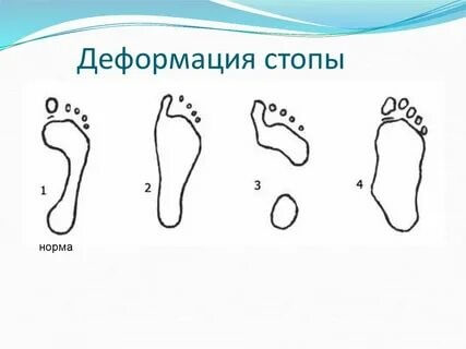 Возрастная стопа