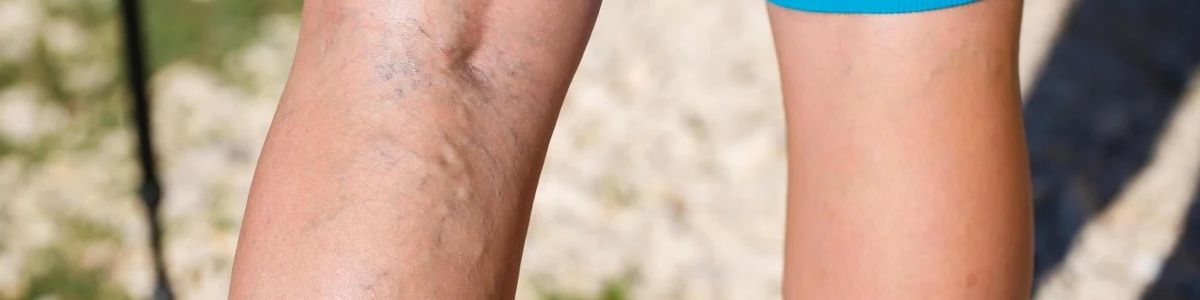 Laser cu vene varicoase pre - Dieta de la venele venelor pe picioare