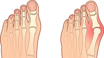 hallux valgus. Проблема большого пальца стопы.