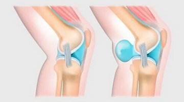 Киста Бейкера. Избавиться или научиться с ней жить