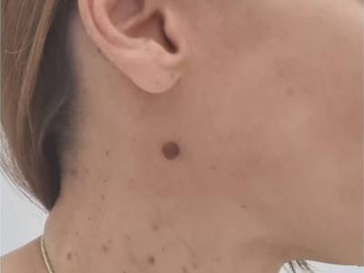 Удаление новообразований аппаратом Сургитрон