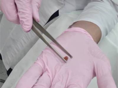 Удаление новообразований аппаратом Сургитрон