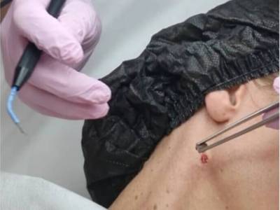 Удаление новообразований аппаратом Сургитрон