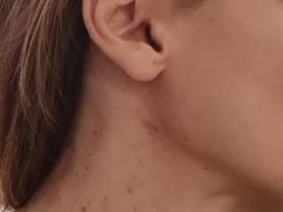 Удаление новообразований аппаратом Сургитрон